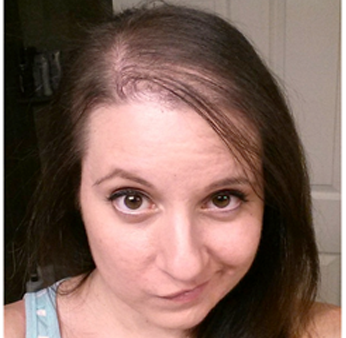HAIR FALL